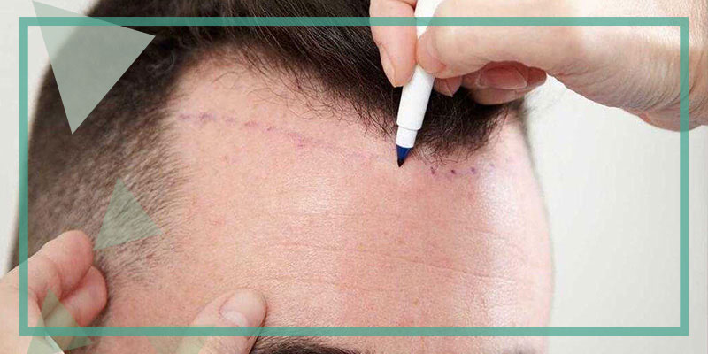 What is Unshaved Hair Transplantation?